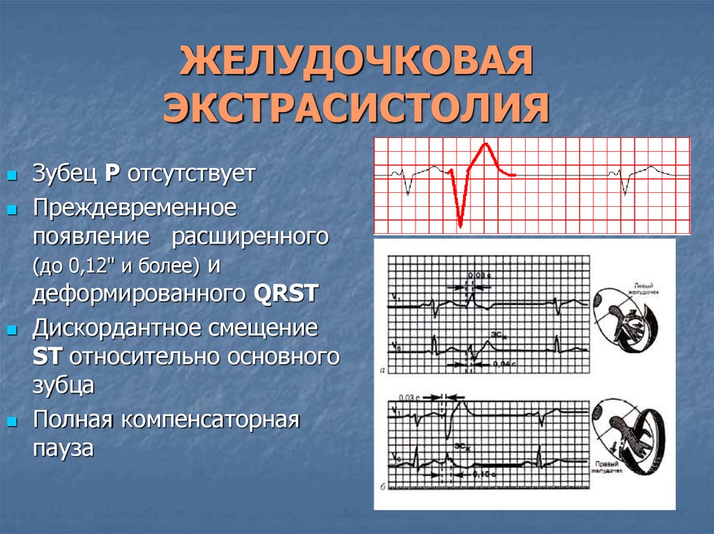 Экстрасистолия сердца что это. Экстрасистолия график. Блокирования экстрасистолия. Дискордантный зубец. Экстрасистолия у подростков.