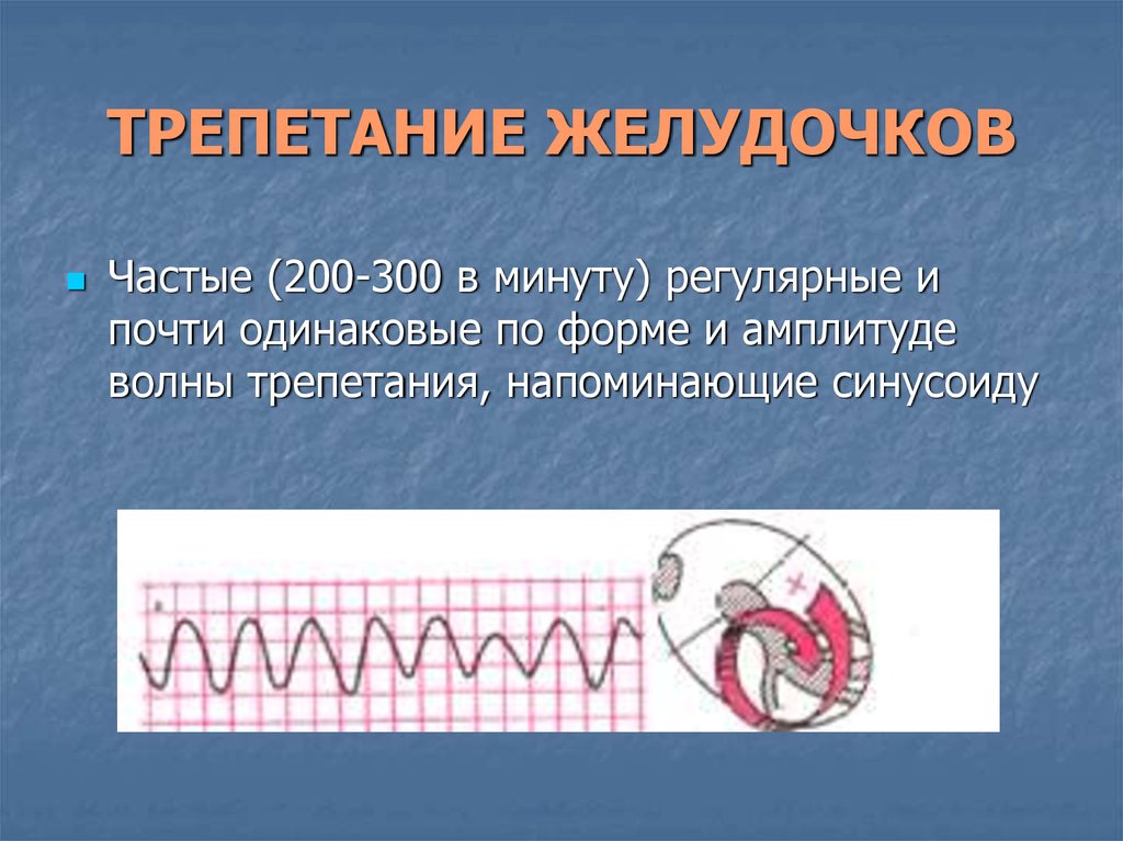 Аритмии презентация факультетская терапия