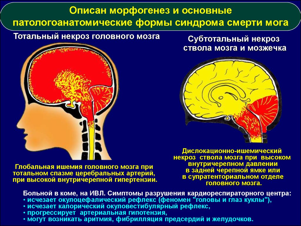 Косвенное внутричерепная гипертензия. Супратенториальные отделы мозга. Ишемический некроз мозга. Супратенториальная ишемии головного мозга.