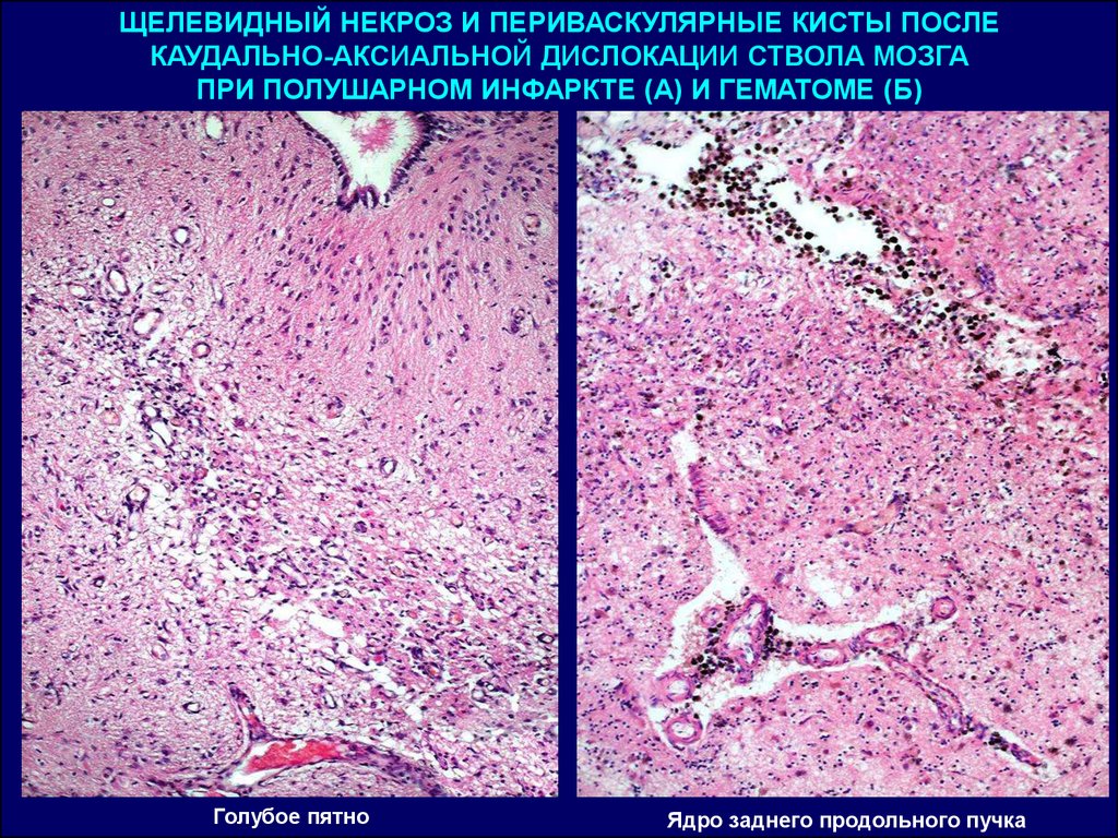 Патанатомия это. Периваскулярный некроз. Инфаркт патологическая анатомия. Периваскулярные кисты.