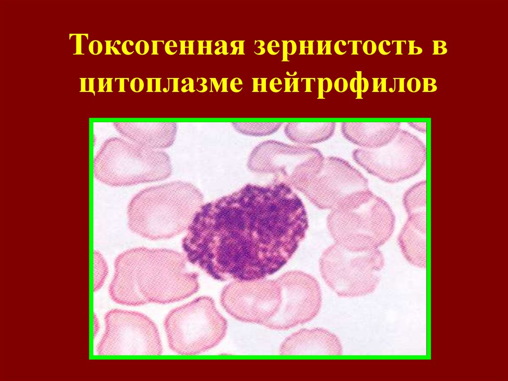 Токсогенная зернистость нейтрофилов. Токсическая зернистость нейтрофилов. Базофильная зернистость нейтрофилов. Токсикогенная зернистость нейтрофилов. В мазке крови: токсигенная зернистость нейтрофилов.