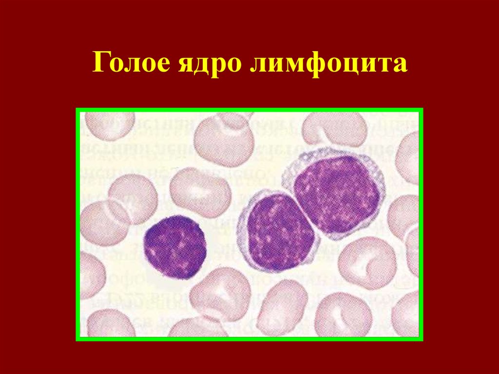 Единичные увеличенные ядра плоского. Широкоплазменные лимфоциты. Лимфоциты ядро. Лимфоциты форма ядра. Атипичные лимфоциты.
