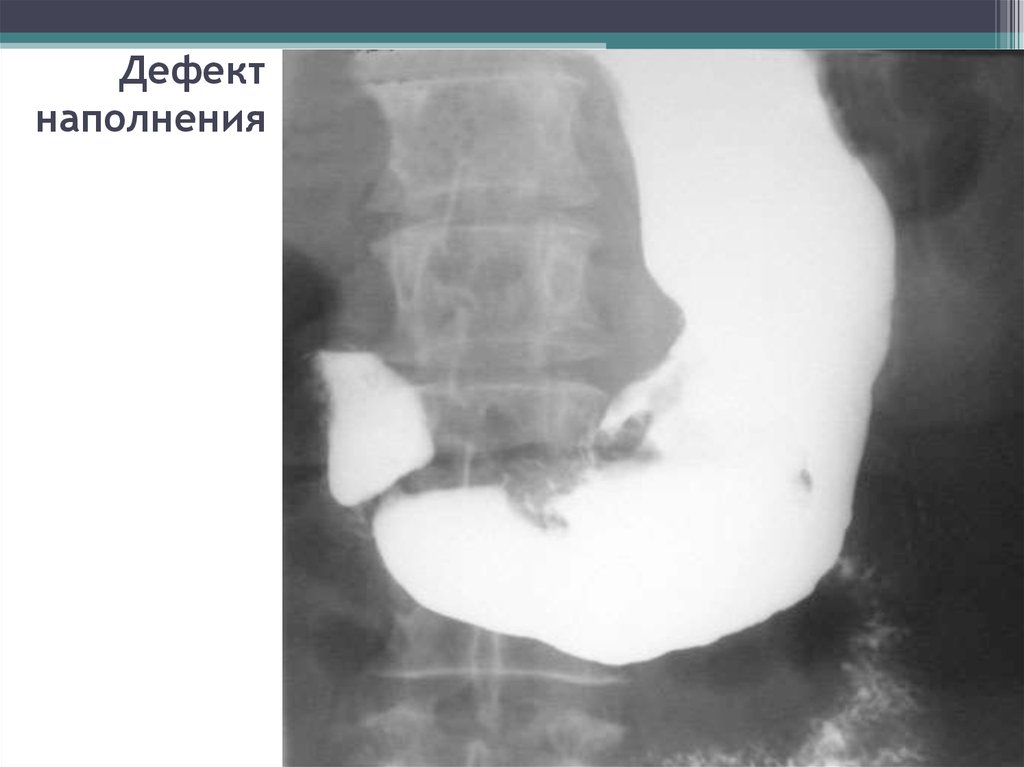 Снимок желудка. Дефект наполнения желудка рентген. Краевой дефект наполнения желудка рентген. Рентгеноскопия желудка дефект наполнения. Дефекты наполнения желудка на рентгенограмме.