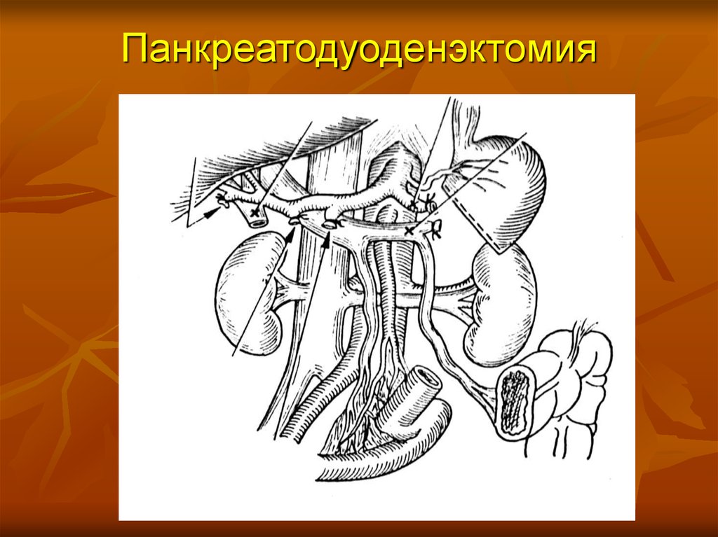 Панкреатодуоденальная резекция схема операции