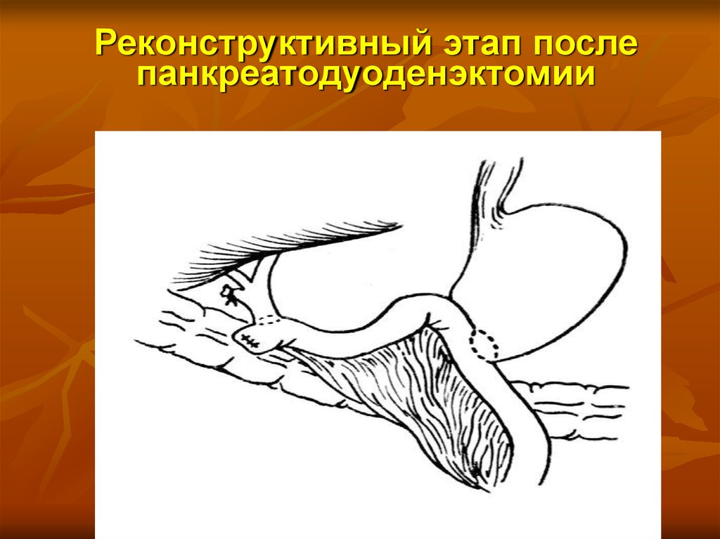 Схема операции. Панкреатодуоденэктомия. Тотальная панкреатодуоденэктомия. Панкреатодуоденэктомия этапы. (Панкреатодуоденэктомия топографическая анатомия.