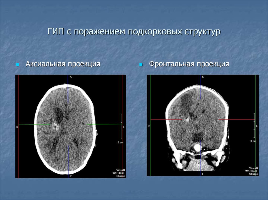 Гипоксически ишемическое поражение головного. Кт головного мозга в аксиальной проекции. Гипоксически-ишемическое поражение головного мозга кт. Проекции компьютерной томографии. Фронтальная проекция кт мозга.