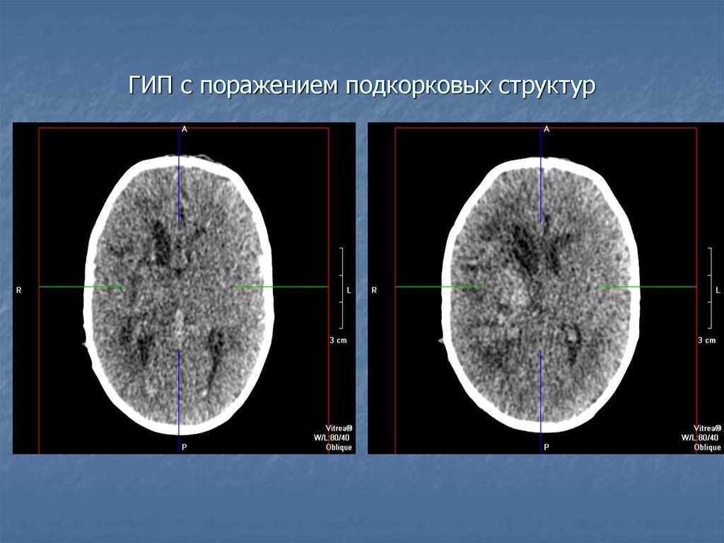 Подкорковые структуры. Поражение подкорковых структур. Структуры головного мозга на кт. Подкорковые структуры мозга кт. Гипоксически-ишемическое поражение головного мозга кт.