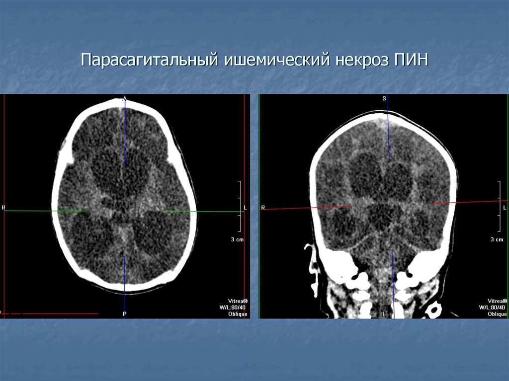 Поражение мозга у новорожденных. Гипоксически-ишемическое поражение головного мозга кт. Ишемическое поражение головного мозга на кт. Гипоксические изменения головного мозга на кт.