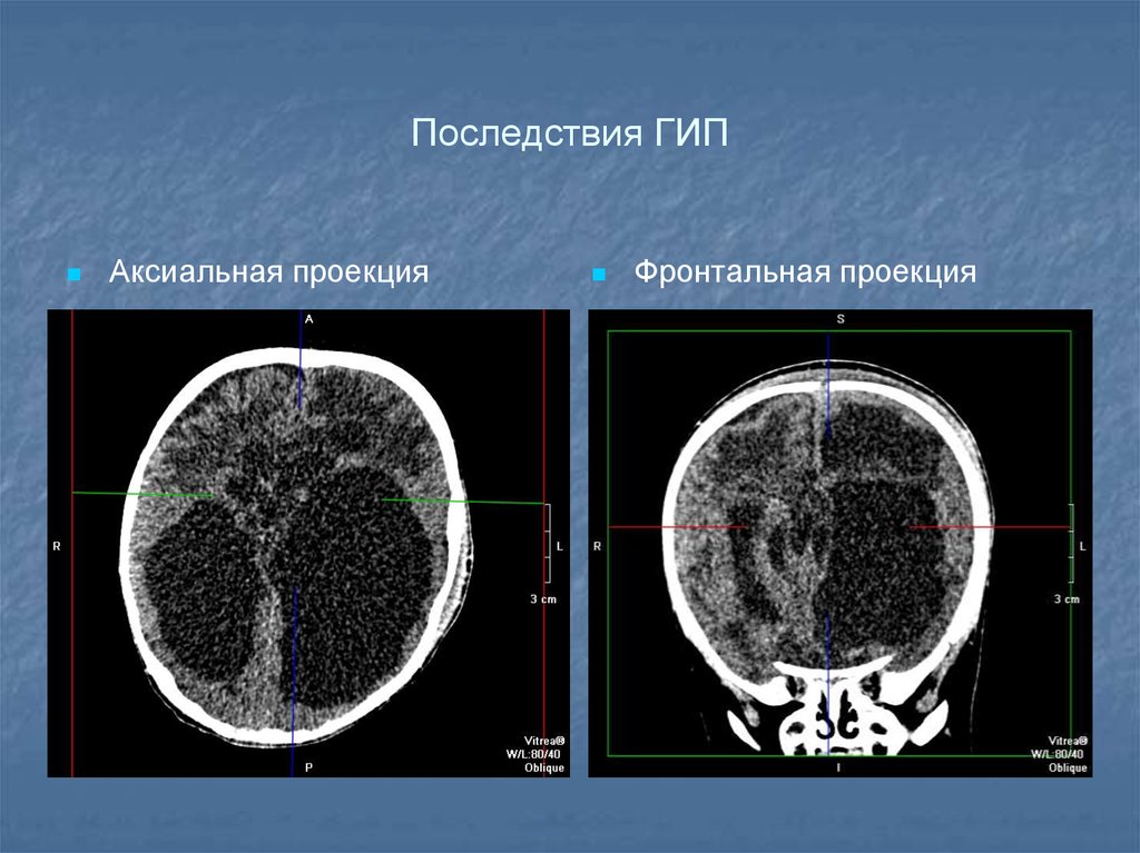 Аксиальная проекция. Гипоксически-ишемическое поражение головного мозга кт. Аксиальная проекция кт. Кт головного мозга проекции. Аксиальная проекция головного мозга.