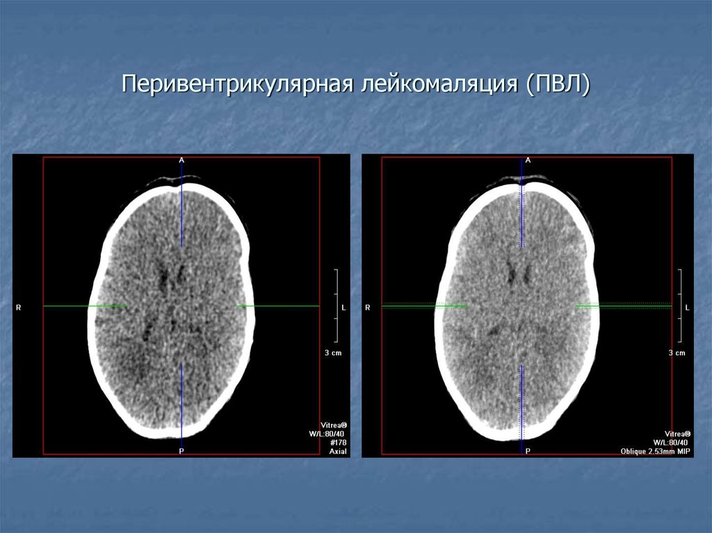 Лейкомаляция головного мозга