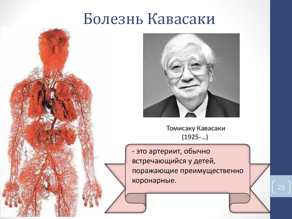 Болезнь Кавасаки