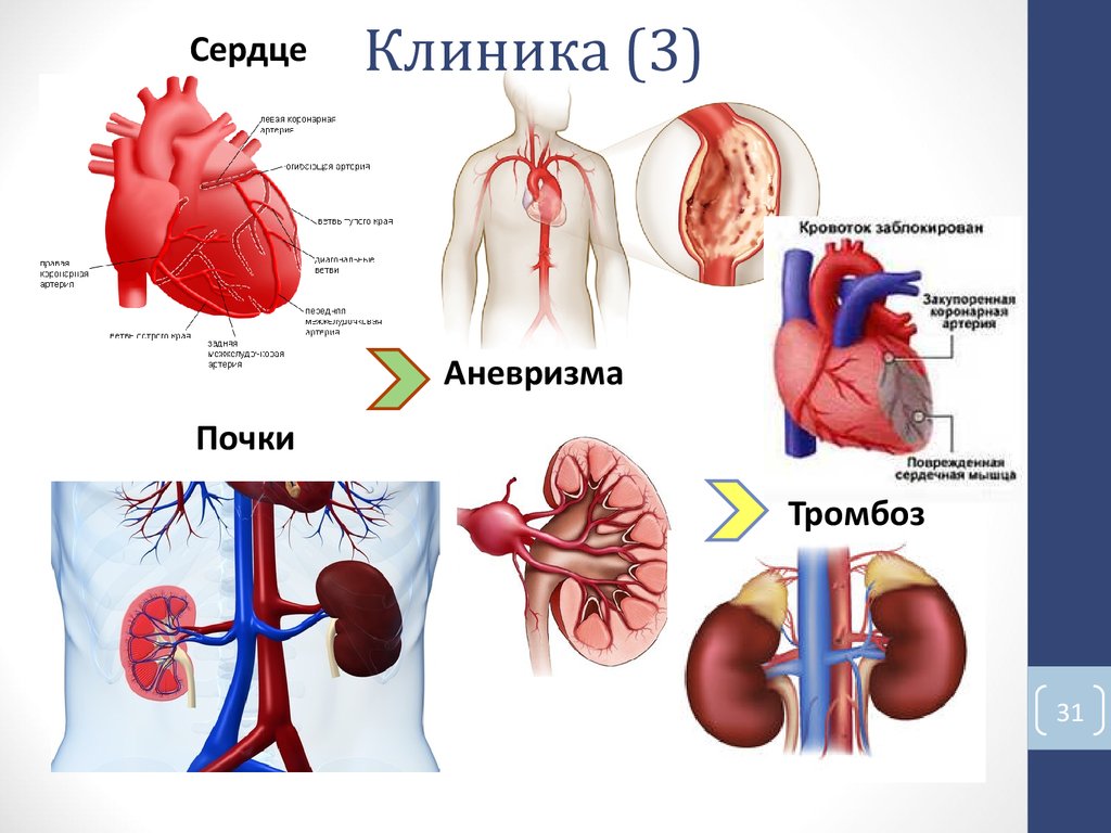 Аневризма сердца. Классификация аневризм сердца. Хроническая аневризма. Аневризма сердца клиника.