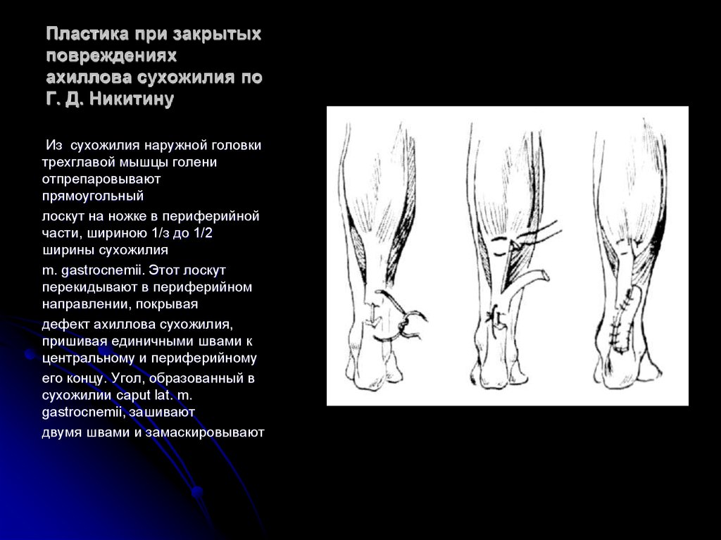 Презентация операции на сухожилиях