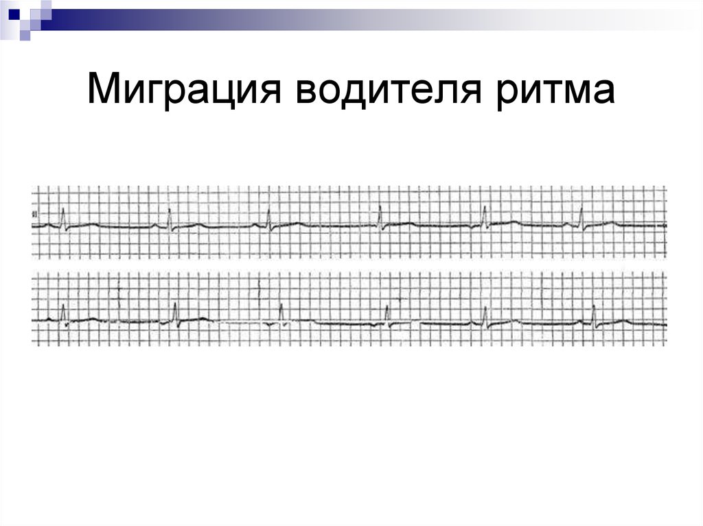 Миграция водителя ритма. Миграция предсердного водителя ритма. ЭКГ при миграции водителя ритма. Миграция суправентрикулярного водителя ритма на ЭКГ. Признаки миграции водителя ритма на ЭКГ.