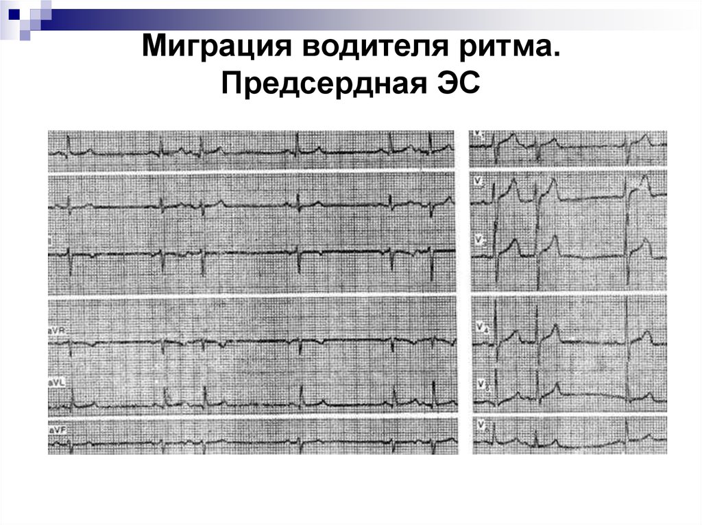 Миграция водителя ритма на экг у ребенка причины