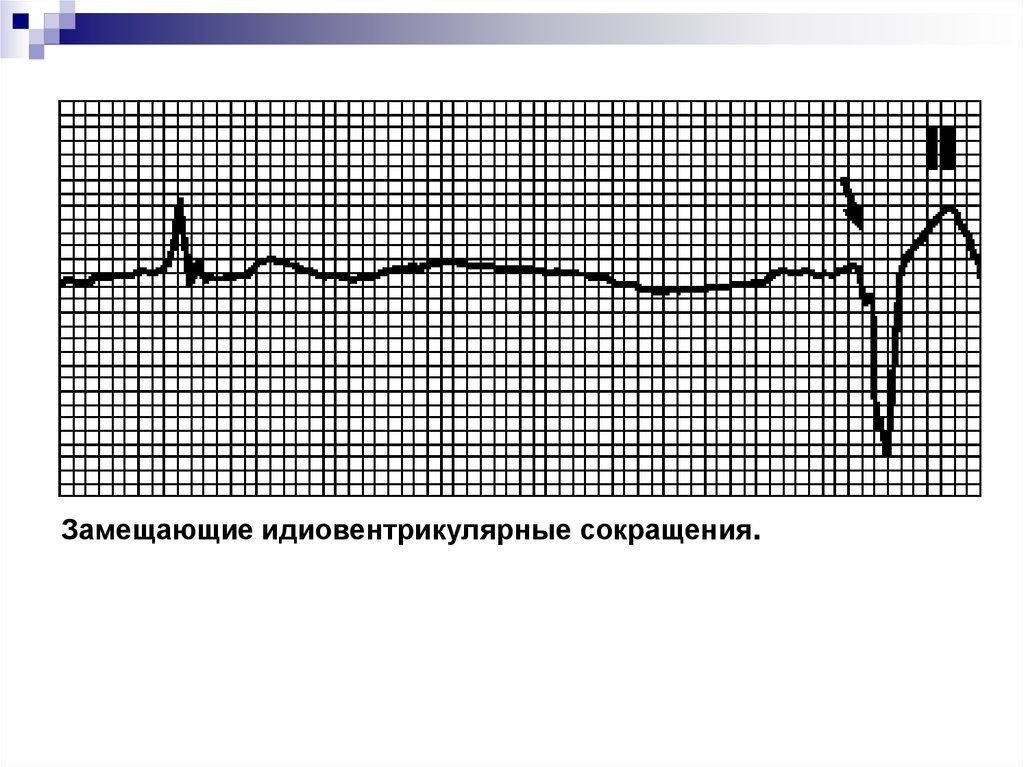 Эктопический это. Эктопический ритм. Замещающий идиовентрикулярный ритм. Эктопический предсердный ритм. Сокращения при идиовентрикулярном ритме.