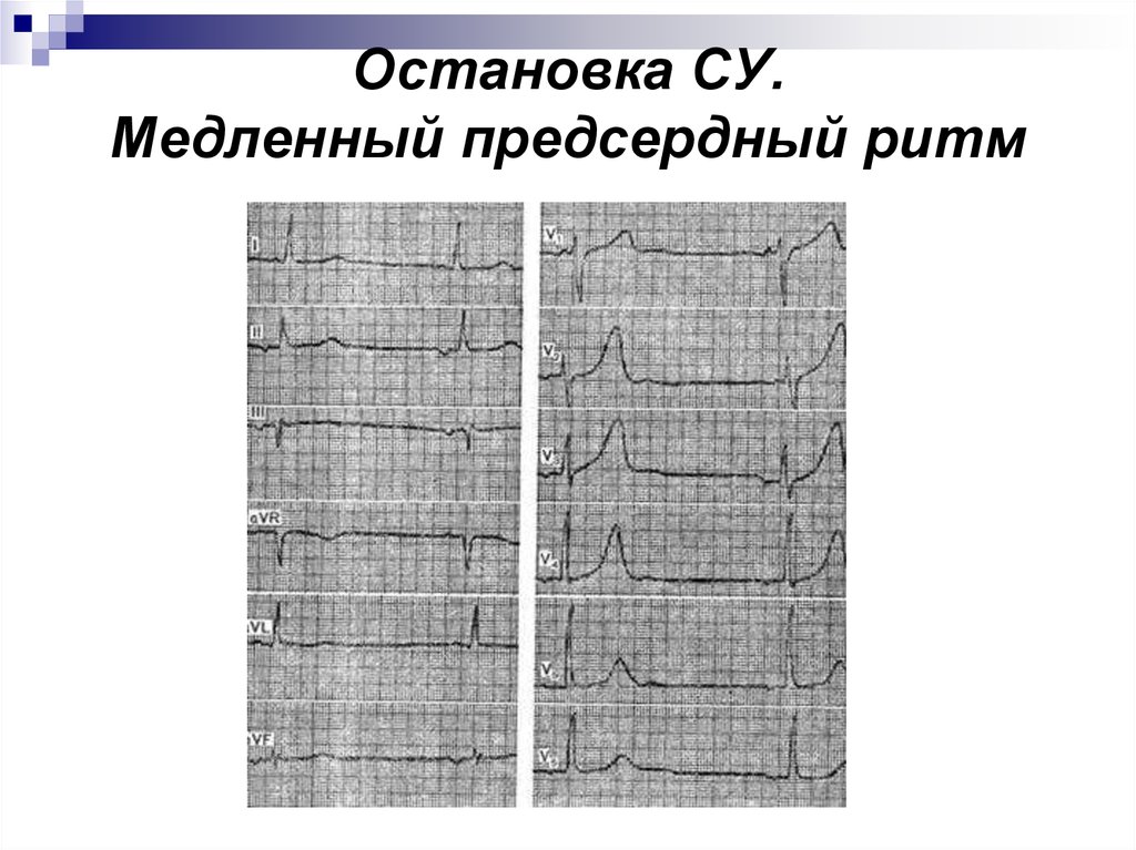 Предсердный ритм. Предсердный ритм на ЭКГ. Эктопический правопредсердный ритм на ЭКГ. Предсердный медленный ритм на ЭКГ. ЭКГ при предсердном ритме.