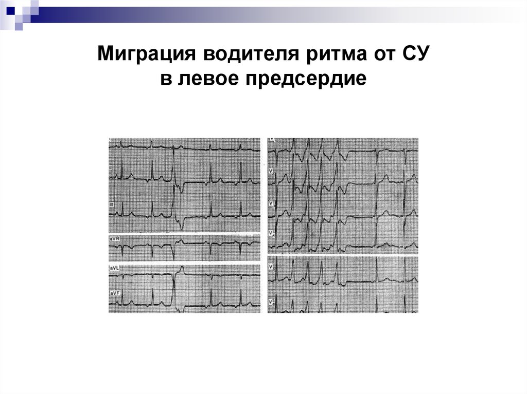 Миграция водителя ритма. Миграция предсердного водителя ритма ЭКГ. Наджелудочковой миграции водителя ритма. Миграция водителя ритма и наджелудочковая экстрасистолия. Трепетание предсердий миграция водителя ритма.