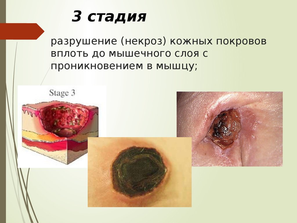 разрушение (некроз) кожных покровов вплоть до мышечного слоя с проникновением в мышцу;