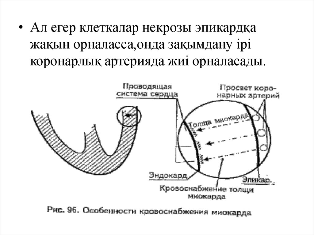 Составьте план обследования пациента с инфарктом миокарда противопоказания к коронароангиографии