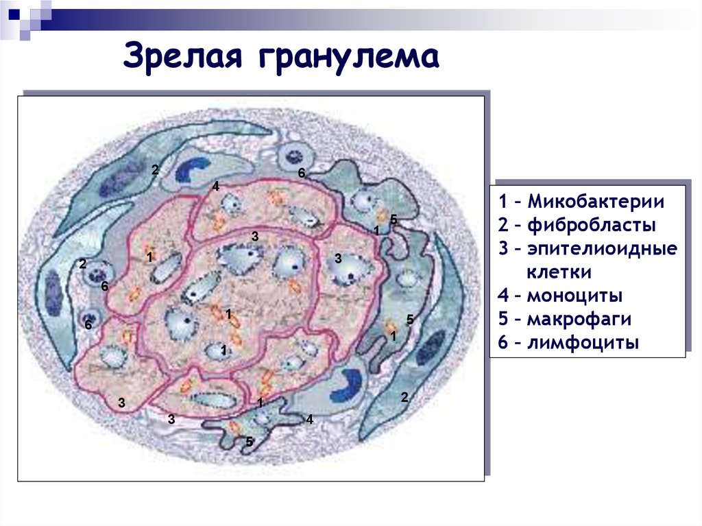 Туберкулезная гранулема рисунок