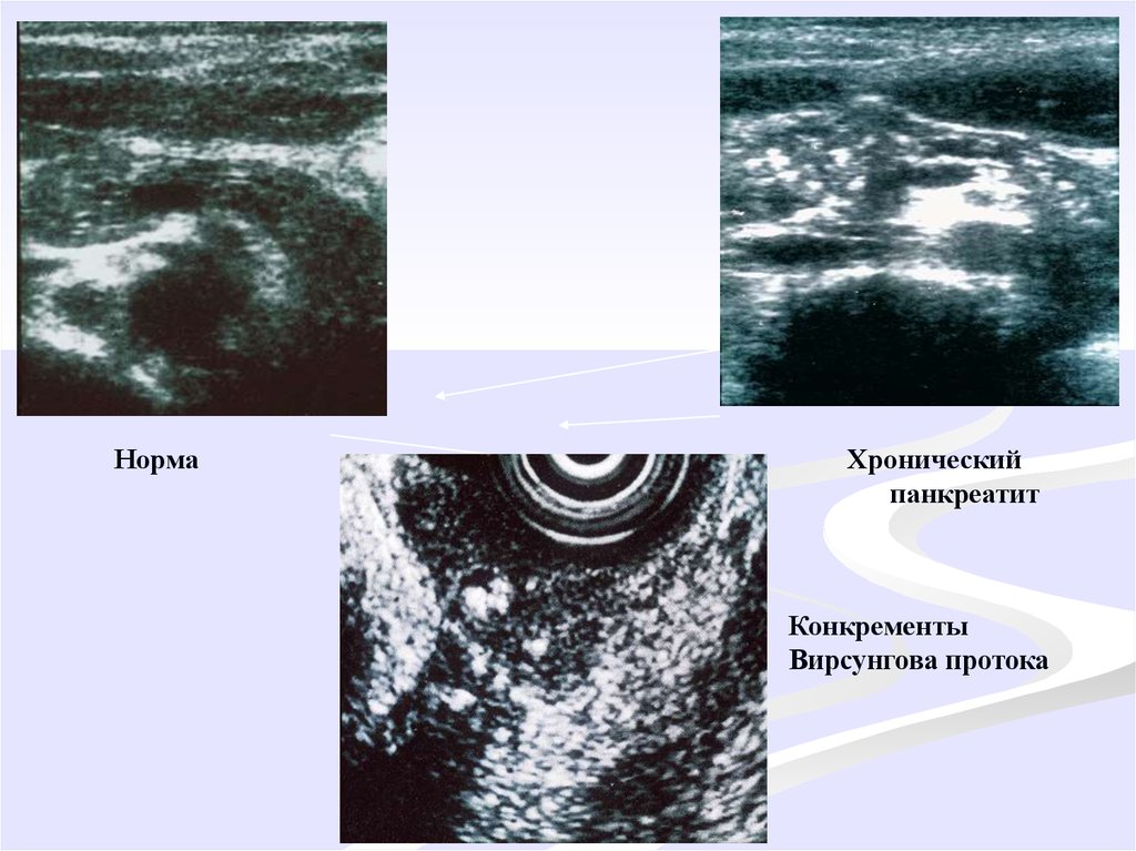 Расширен проток поджелудочной. Расширение вирсунгова протока по УЗИ. Расширение вирсунгова протока поджелудочной железы на УЗИ. Расширение вирсунгова протока на УЗИ. Камень в вирсунговом протоке поджелудочной железы.