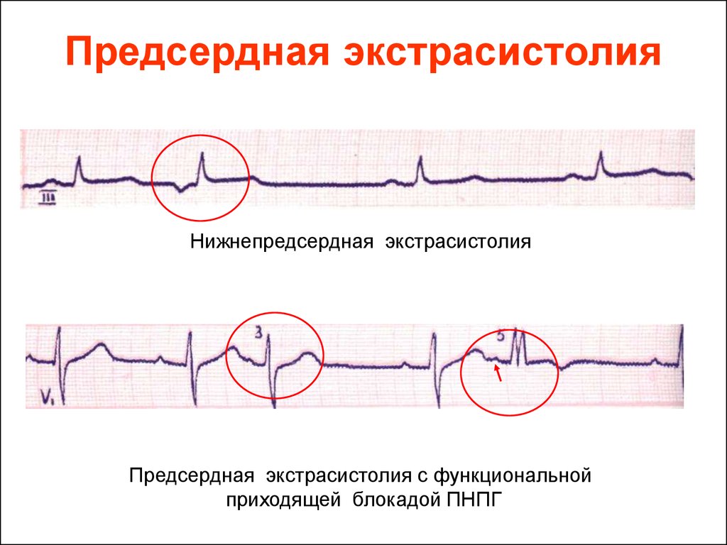 Экстрасистолия это. Экстрасистола предсердия на ЭКГ. Предсердные экстрасистолы на ЭКГ. Одиночная предсердная экстрасистола на ЭКГ. Экстрасистолия предсердий на ЭКГ.