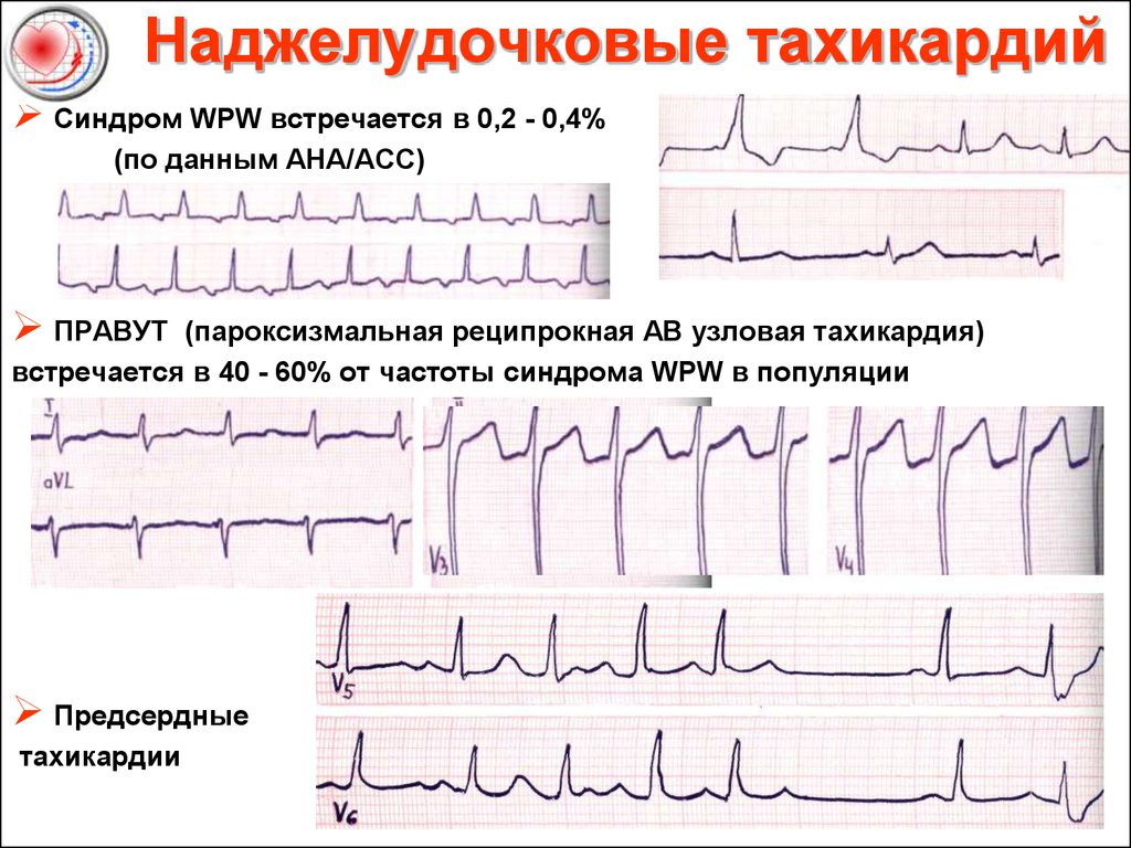 Наджелудочковая пароксизмальная тахикардия на экг фото