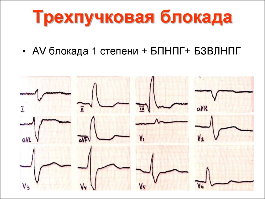 Блокады на экг фото и обозначения расшифровка