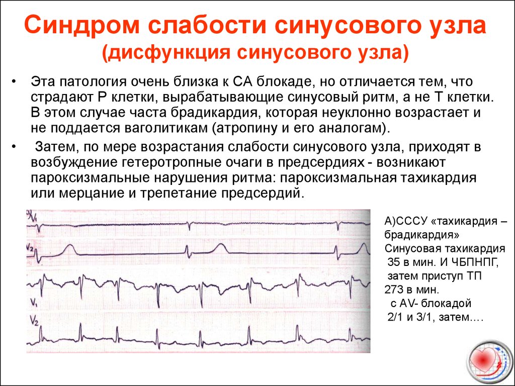 Синусовая вегетативная дисфункция