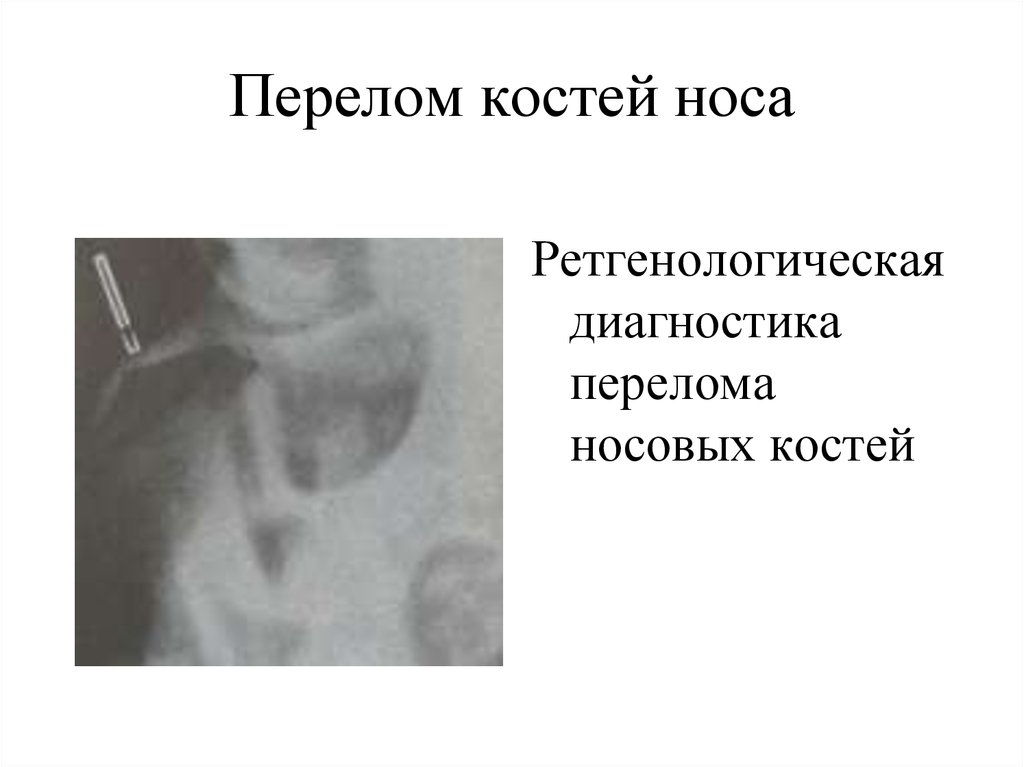 Диагноз трещина. Кости носа рентген норма. Перелом хряща носа рентген. Переломы костей носа рентген классификация. Переломы костей носа. : Классификация, клиника.