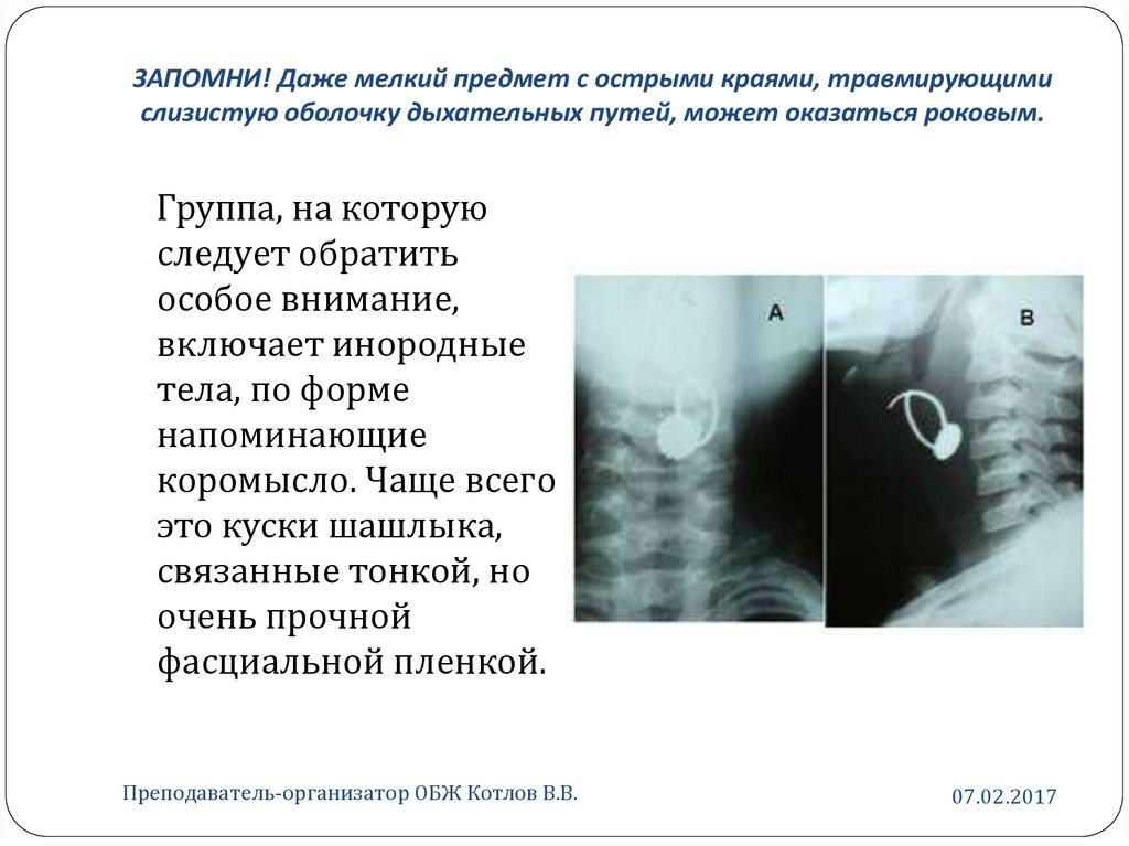 Инородные тела дыхательных путей презентация