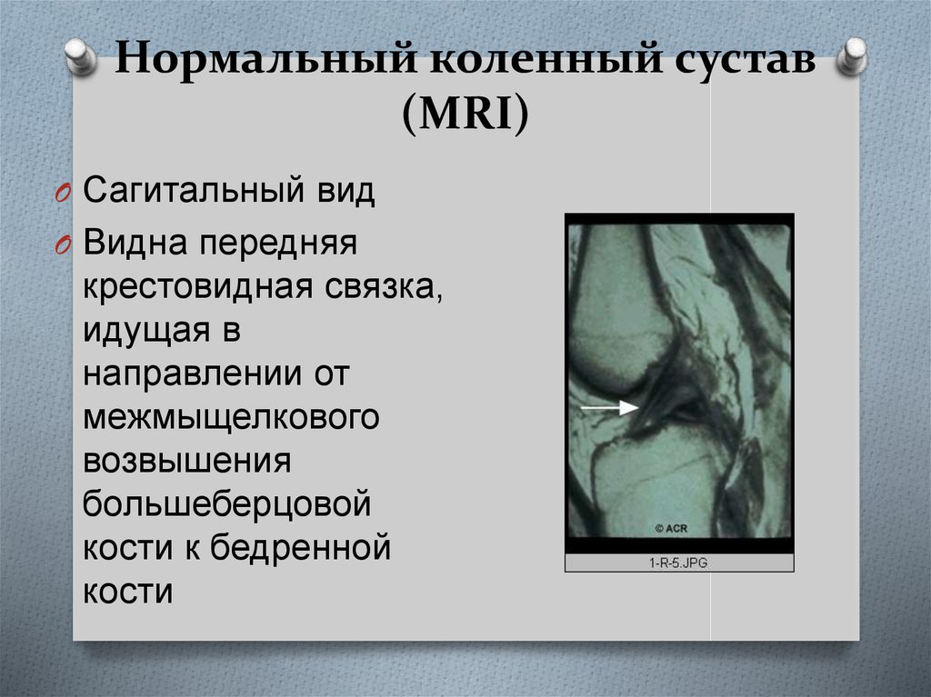 Нормальный коленный сустав (MRI)