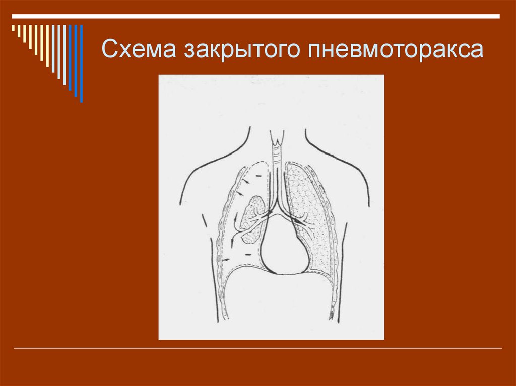 Закрытый пневмоторакс это