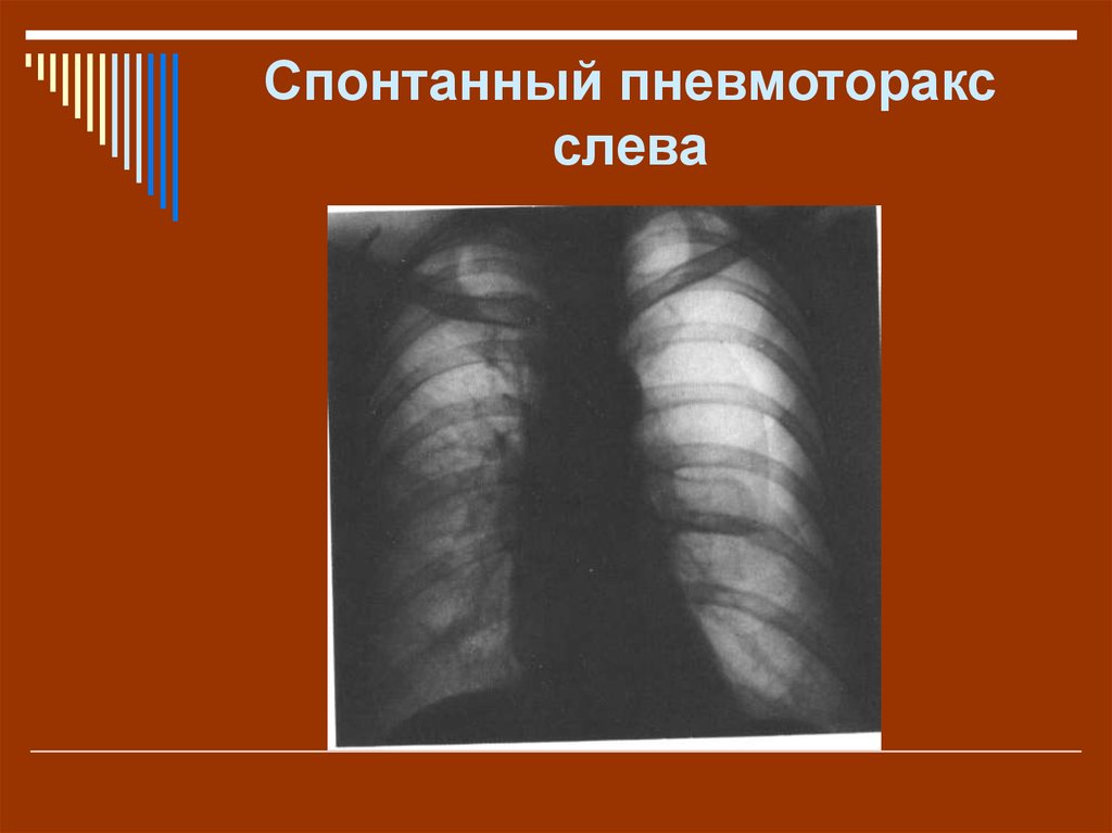 Спонтанный пневмоторакс. Ятрогенный спонтанный пневмоторакс. Первичный спонтанный пневмоторакс. Вторичный спонтанный пневмоторакс.