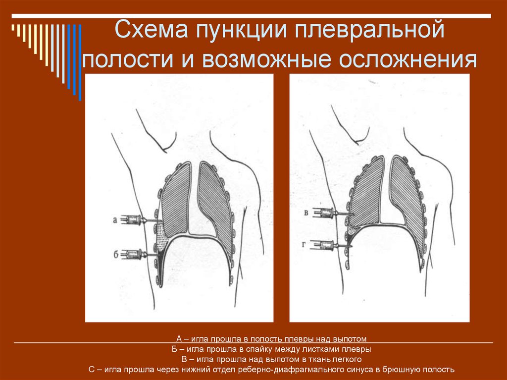 Осложнения после пункции