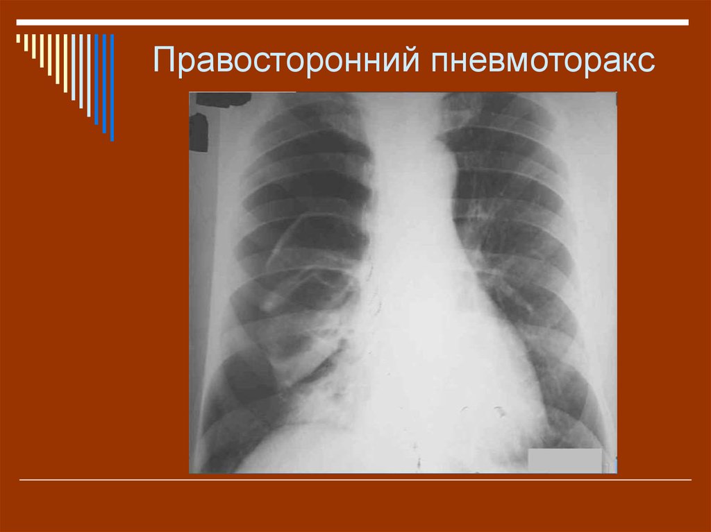 Рентген картина пневмоторакса