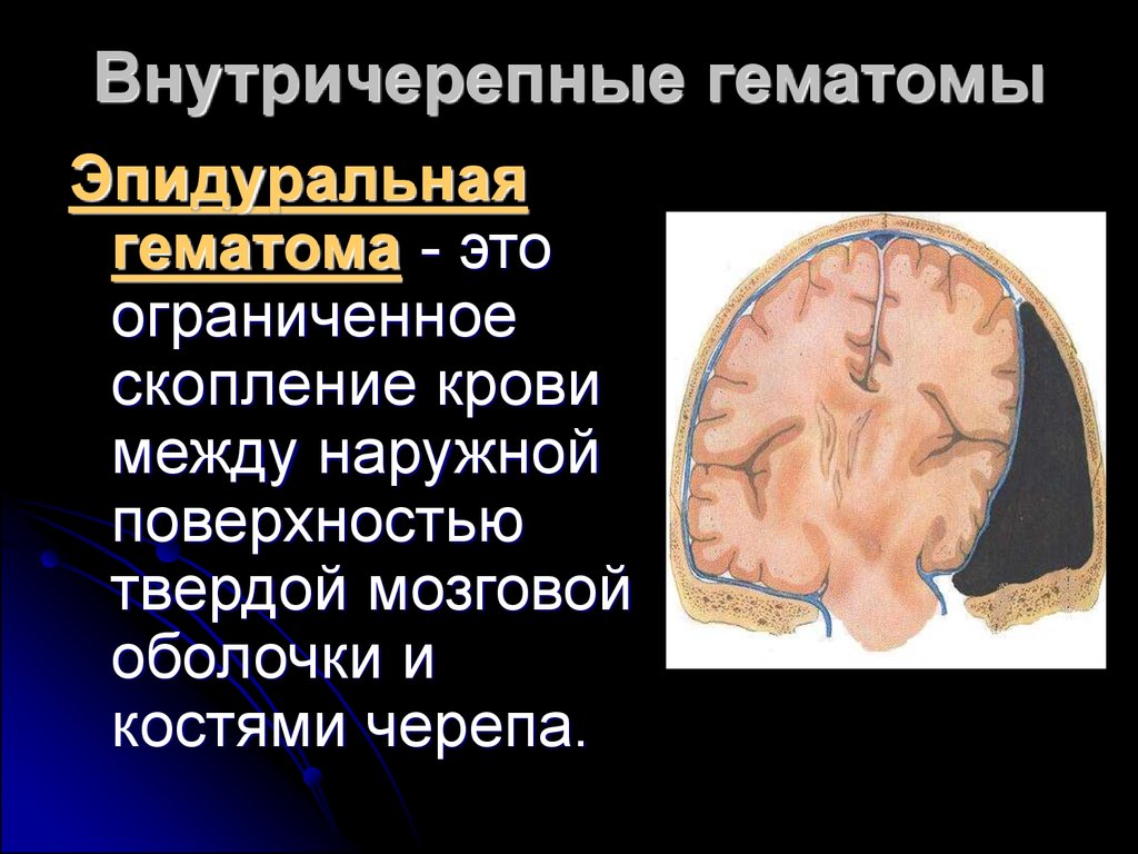 Черепно мозговые гематомы