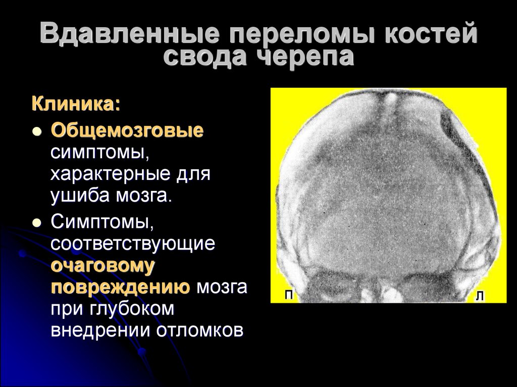 Очаговые симптомы головного мозга. Клиника перелома основания и свода черепа.. Перелом основания свода черепа симптомы. Клинические проявления при переломе костей черепа. ЧМТ перелом свода черепа.