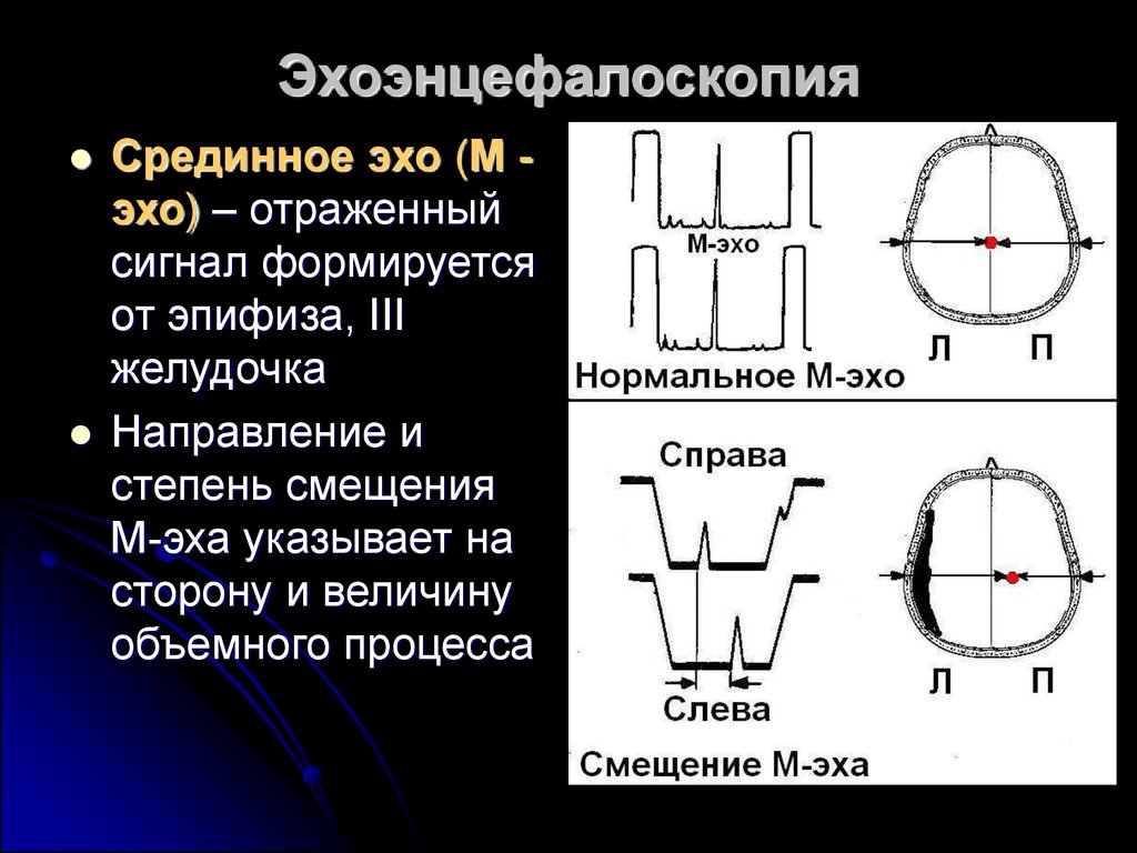 Что значит эхо. Эхоэнцефалоскопия. Эхоэнцефалоскопия головы. Эхоэнцефалоскопия (м-Эхо). Эхоэнцефалоскопия, методика.