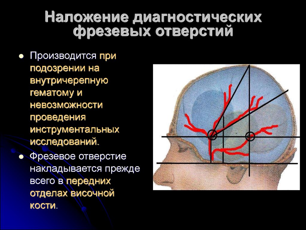 Схема кренлейна черепно мозговая