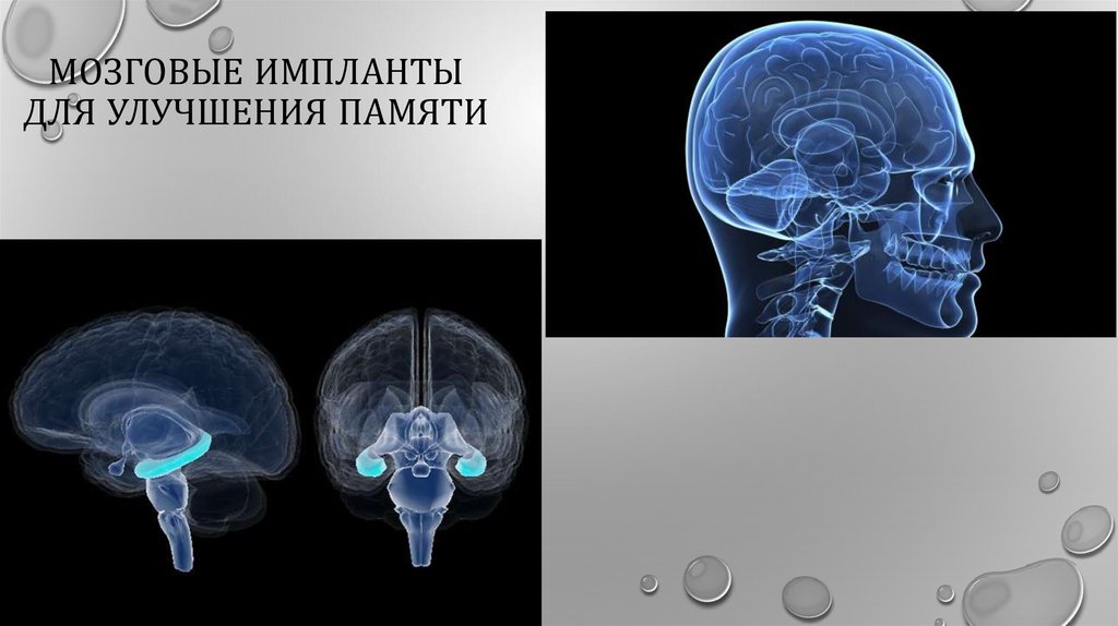 Импланты головного мозга