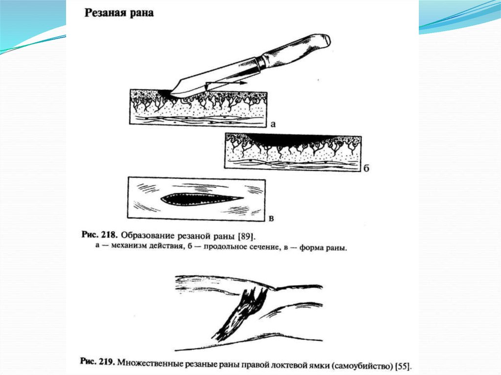 Колото резанный. Колото-резаная рана судебная медицина. Описание колото резаной раны. Схема образования колото-резаных РАН. Характеристика колото резаных РАН.