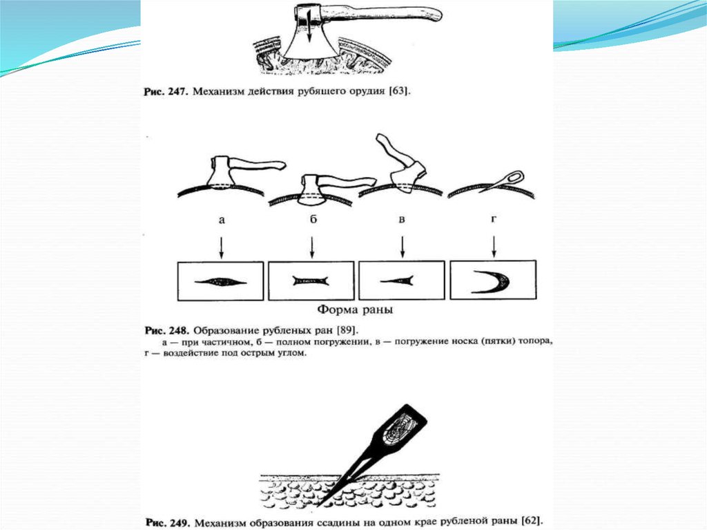 Колото резаных ран. Рубленные повреждения судебная медицина. Рубленые раны судебная медицина. Классификация РАН судебная медицина. Раны судебная медицина классификация.