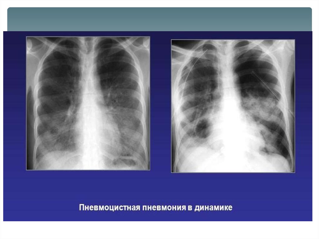 Пневмоцистная пневмония диагноз