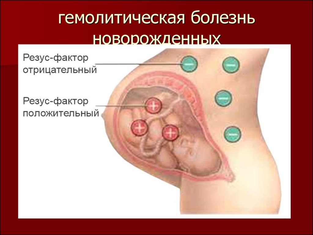 Гемолитическая болезнь новорожденных картинки