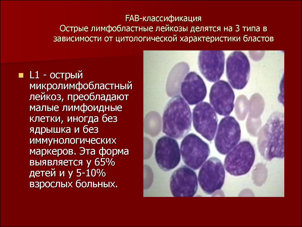 Острый лимфобластный лейкоз. Лимфобластные лейкозы классификация. Бластные клетки лейкоз.