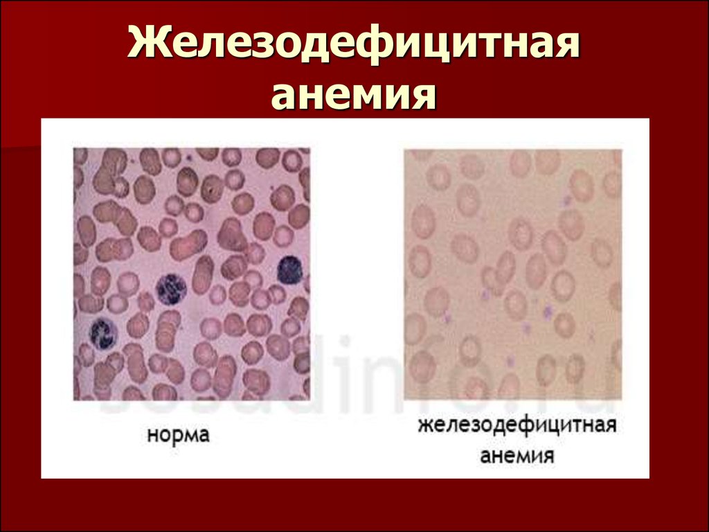 Анемия и эритроциты в крови. Эритроциты при железодефицитной анемии. Железодефицитная анемия в микроскопе. Жда анемия картина крови. Картина мазка крови при железодефицитной анемии.