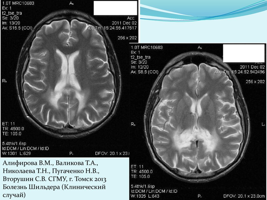 Мр картина демиелинизирующего заболевания головного мозга