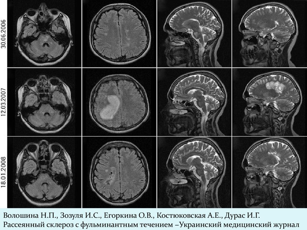 Картина демиелинизирующего процесса головного мозга мр